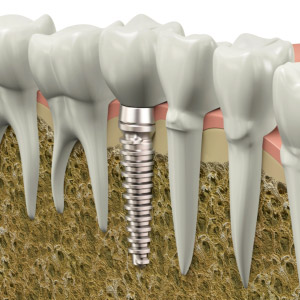 Dental Implants